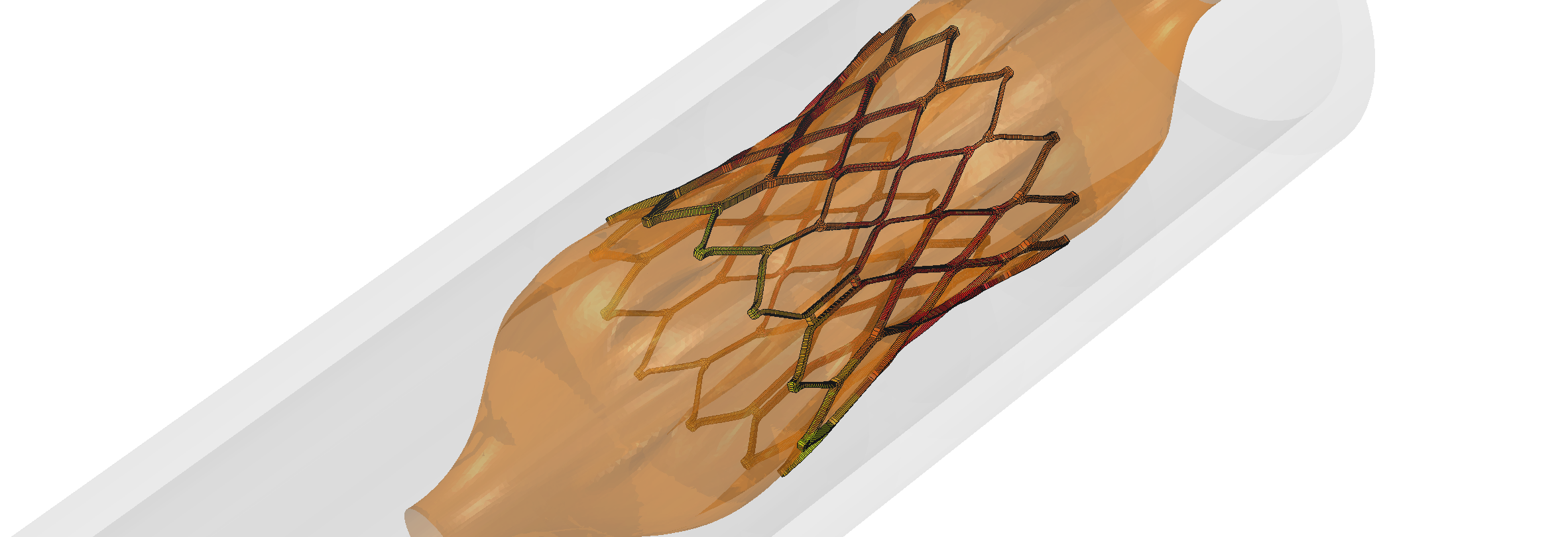 Abaqus FEA simulation of stent medical device